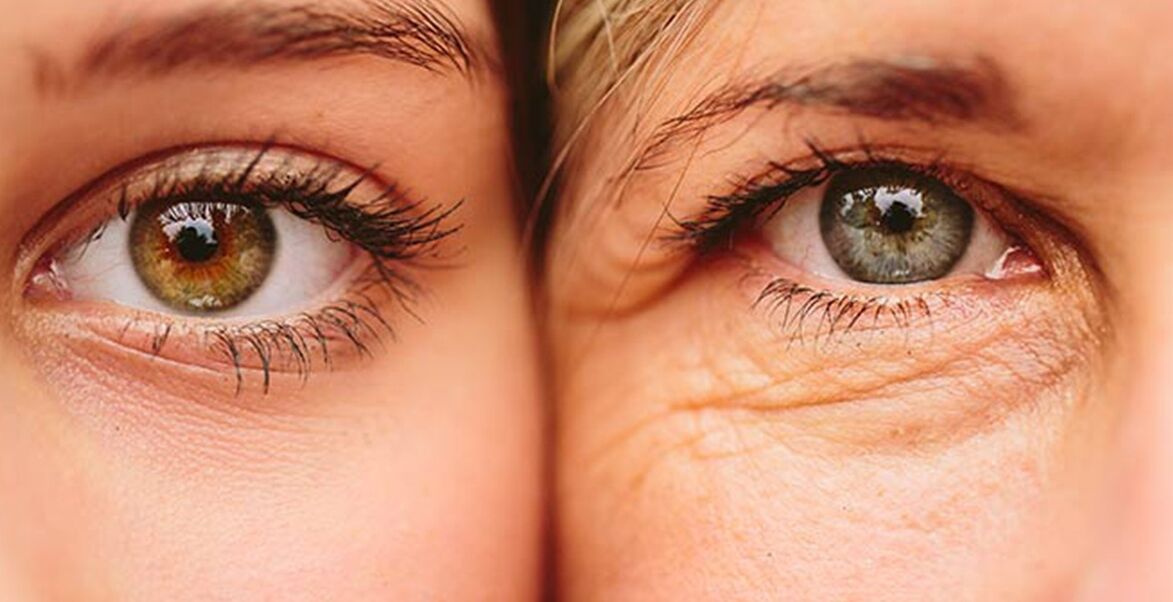 Աչքերի շուրջ մաշկի ծերացման արտաքին նշանները տարբեր տարիքի երկու կանանց մոտ