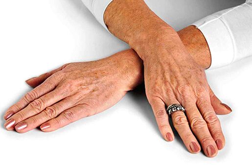 Ձեռքի մաշկ՝ տարիքային փոփոխություններով, որոնք պահանջում են երիտասարդացման տեխնիկայի կիրառում