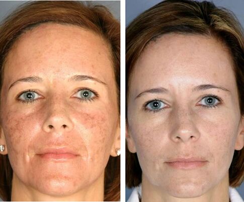 Դեմքի կոտորակային թերմոլիզից առաջ և հետո